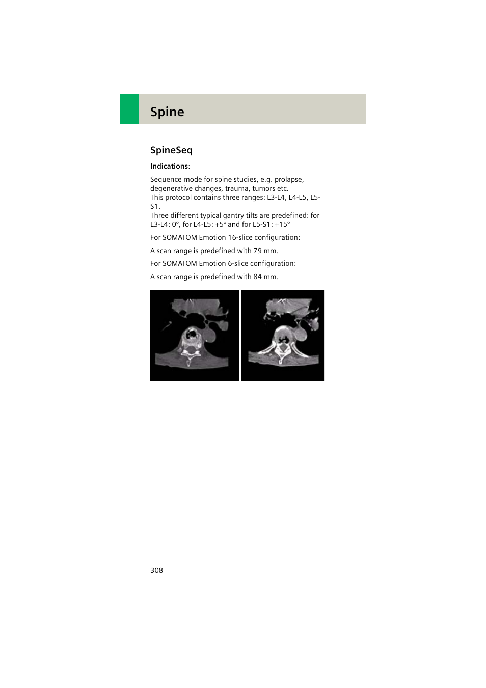 Spineseq, Spineseq 308, Spine | Siemens EMOTION 16-Jun User Manual | Page 308 / 590