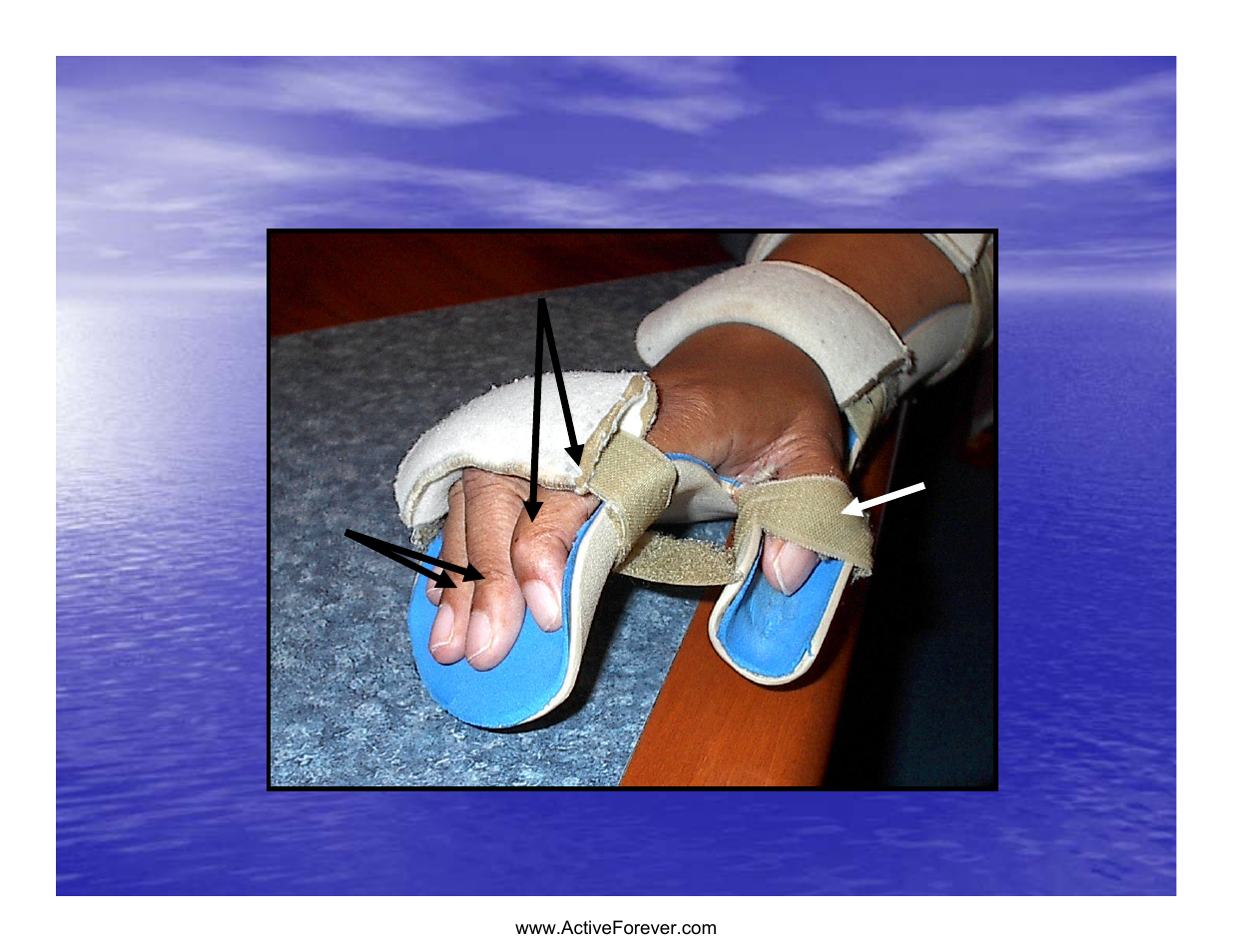 Static hand piece, During, During exertion exertion | Activeforever Saebo Stretch Hand Splint - SaeboStretch User Manual | Page 17 / 38