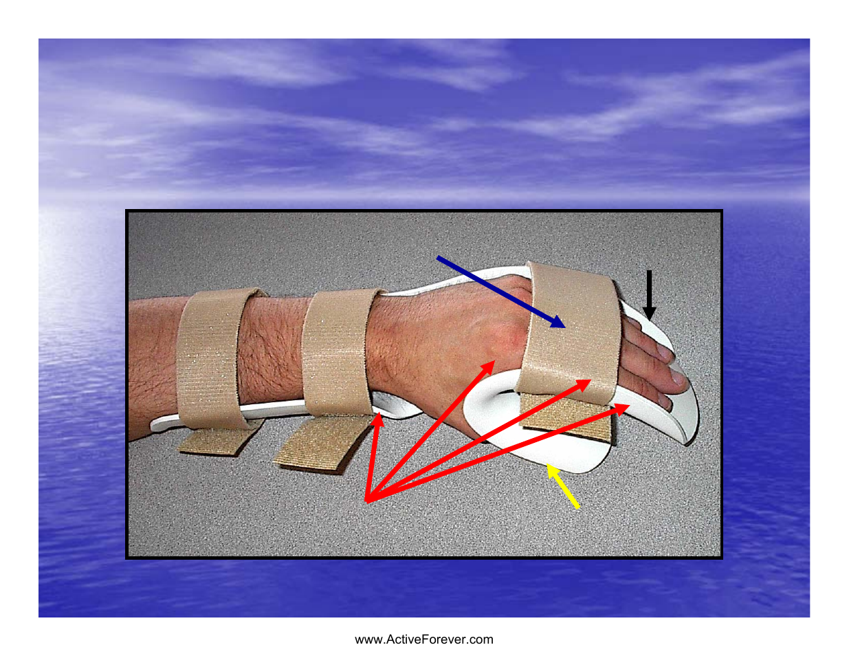 Poor splint design | Activeforever Saebo Stretch Hand Splint - SaeboStretch User Manual | Page 9 / 38