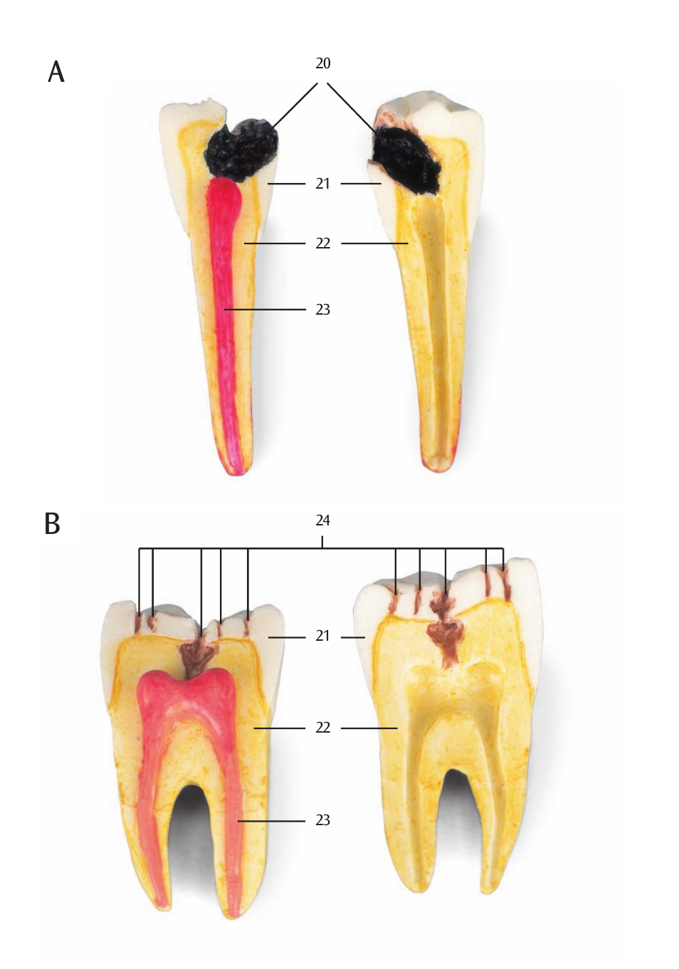 3B Scientific Dental disease, magnified 2 times, 21 parts User Manual | Page 10 / 16