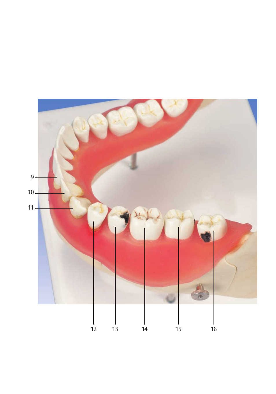 3B Scientific Dental disease, magnified 2 times, 21 parts User Manual | Page 7 / 16