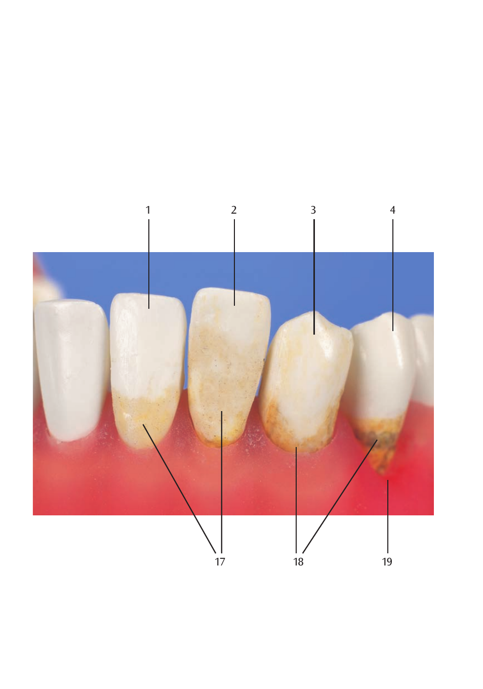 3B Scientific Dental disease, magnified 2 times, 21 parts User Manual | Page 8 / 16