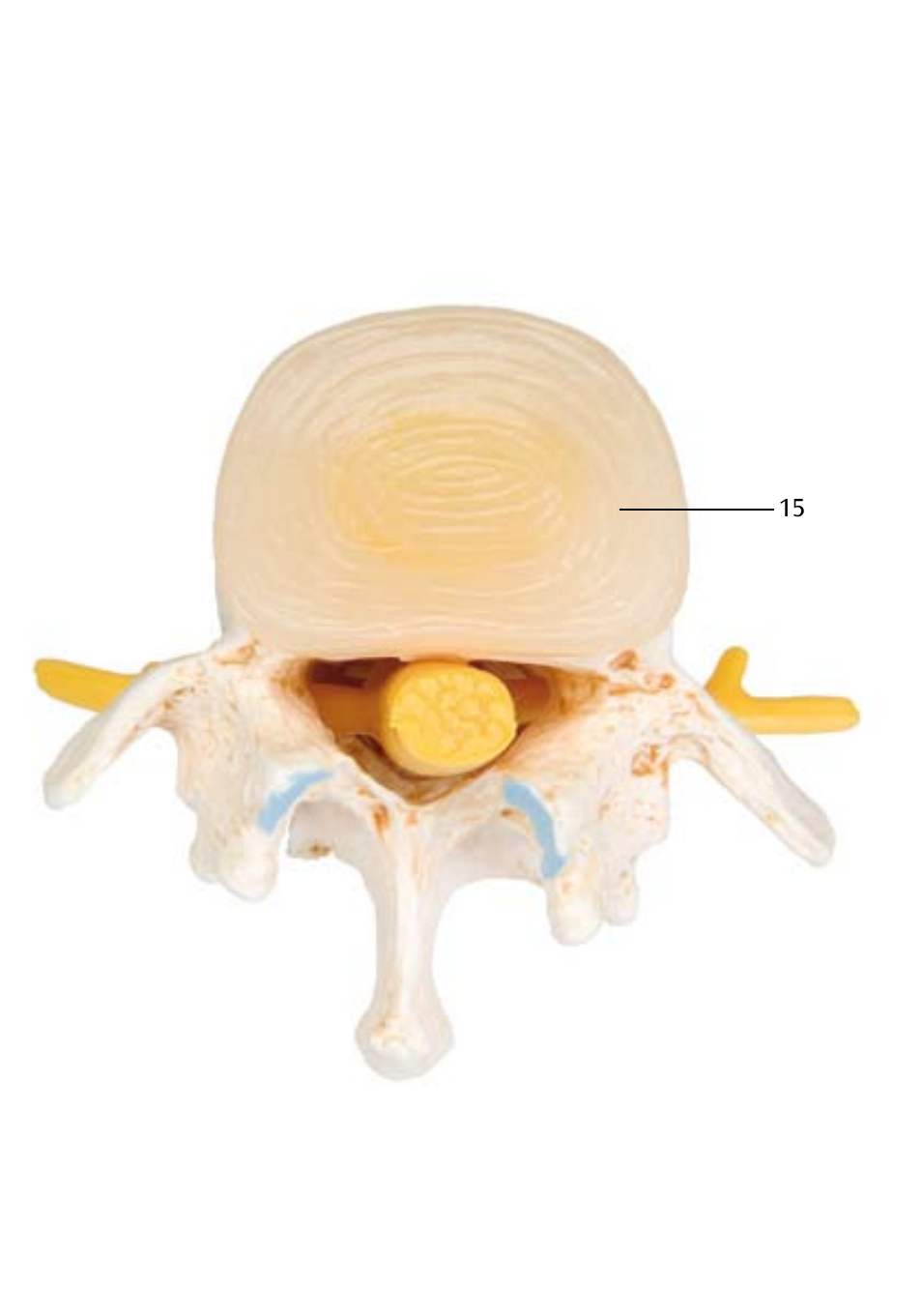 3B Scientific Stages of disc prolapse and vertebral degeneration User Manual | Page 10 / 18