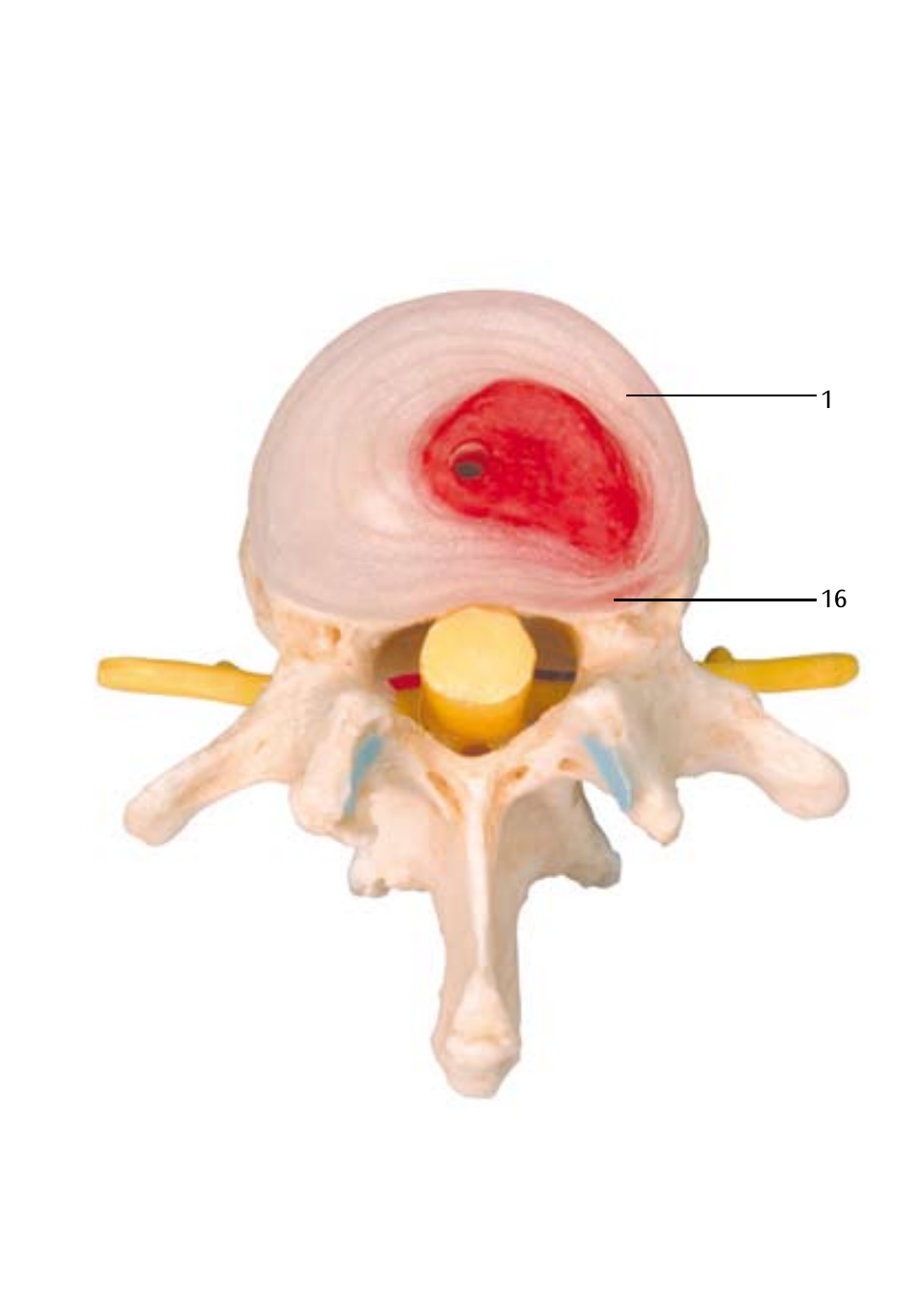 3B Scientific Stages of disc prolapse and vertebral degeneration User Manual | Page 11 / 18