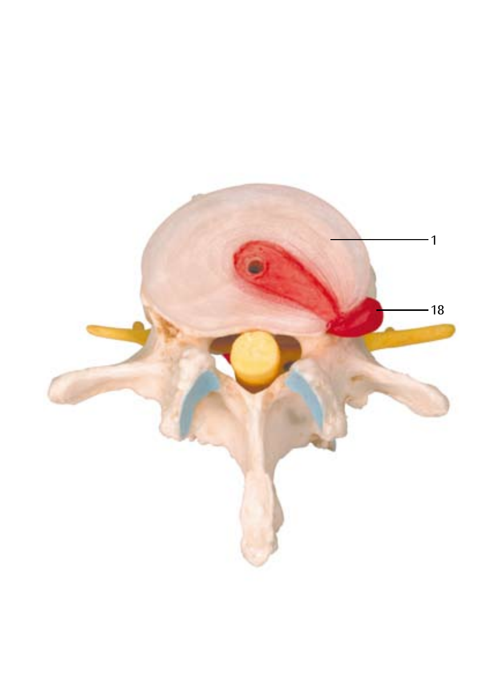 3B Scientific Stages of disc prolapse and vertebral degeneration User Manual | Page 13 / 18