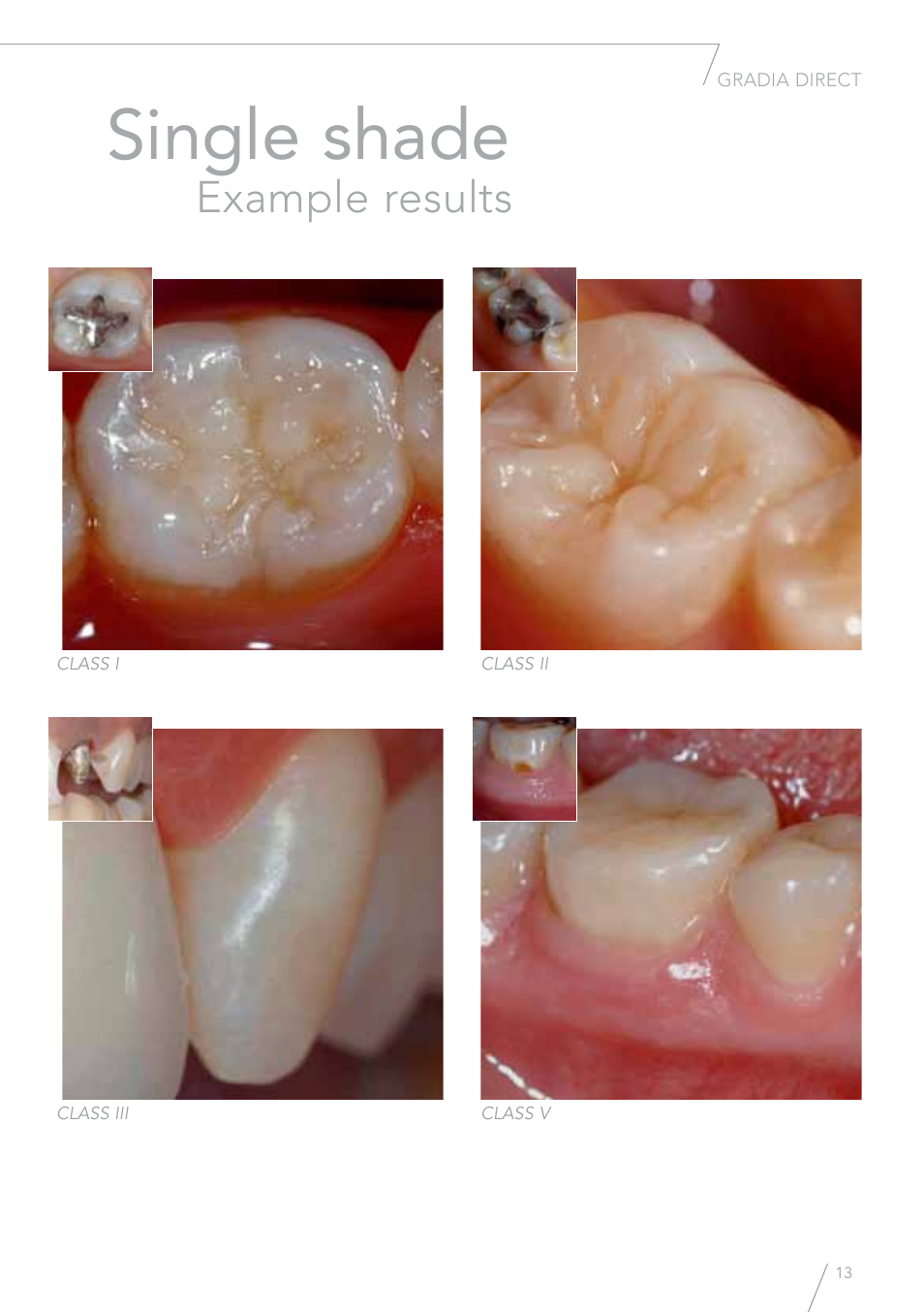 Single shade, Example results | GC EUROPE GRADIA Direct (X) User Manual | Page 13 / 24