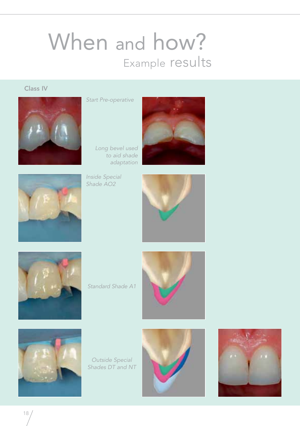 When, Results | GC EUROPE GRADIA Direct (X) User Manual | Page 18 / 24