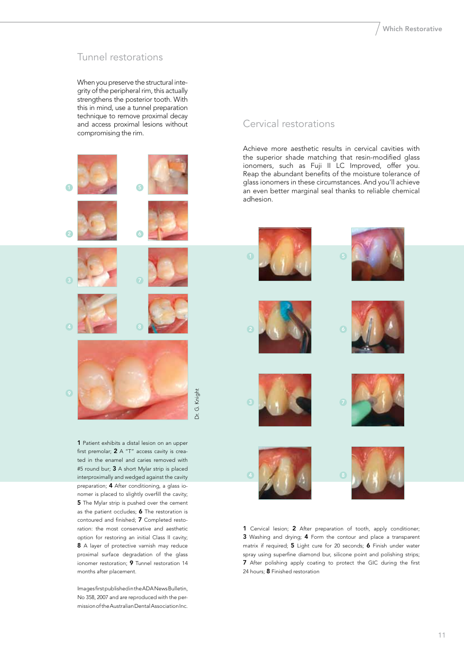 Cervical restorations, Tunnel restorations | GC EUROPE Fuji VIII GP User Manual | Page 11 / 16