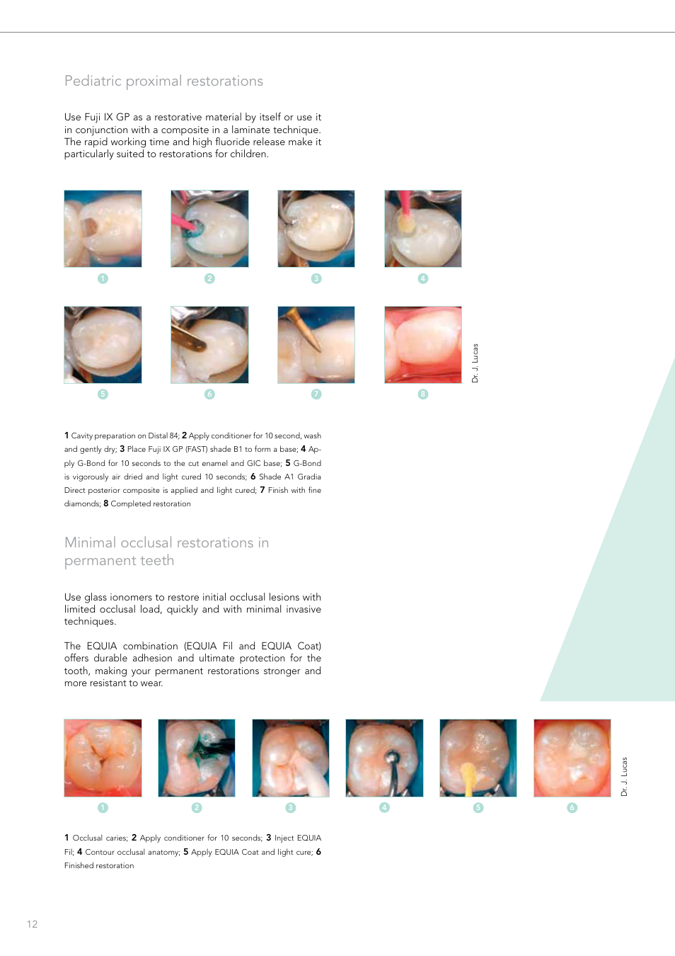 Pediatric proximal restorations, Minimal occlusal restorations in permanent teeth | GC EUROPE Fuji VIII GP User Manual | Page 12 / 16