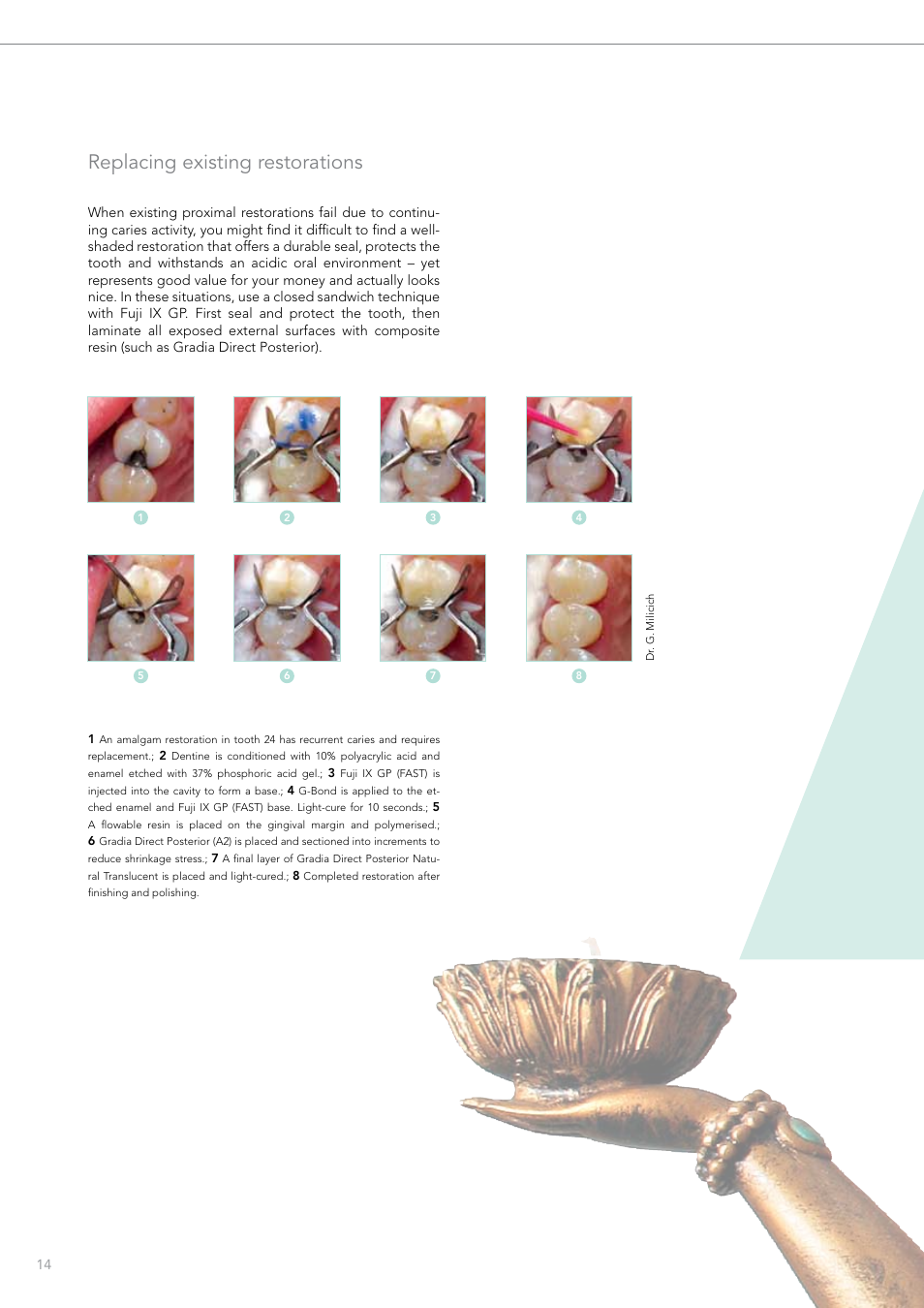 Replacing existing restorations | GC EUROPE Fuji VIII GP User Manual | Page 14 / 16