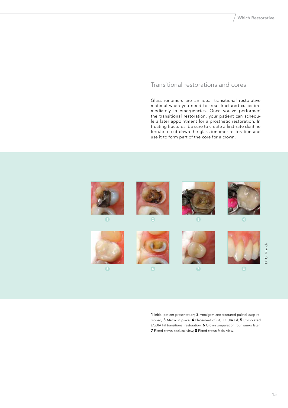 Transitional restorations and cores | GC EUROPE Fuji VIII GP User Manual | Page 15 / 16