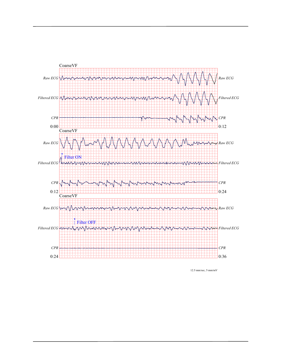 See-thru cpr | ZOLL AED Pro Rev J User Manual | Page 61 / 118