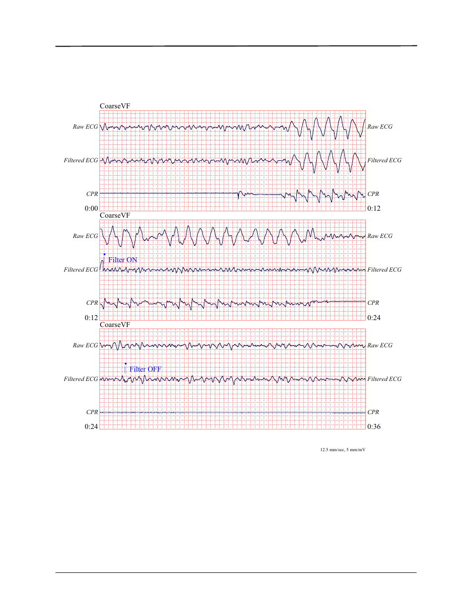 See-thru cpr | ZOLL E Series Monitor Defibrillator Rev R User Manual | Page 63 / 132