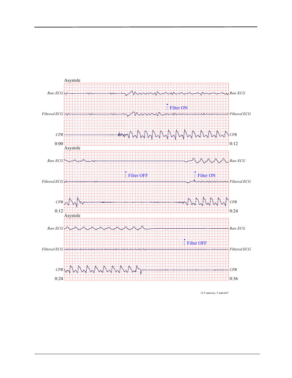 ZOLL E Series Monitor Defibrillator Rev R User Manual | Page 64 / 132