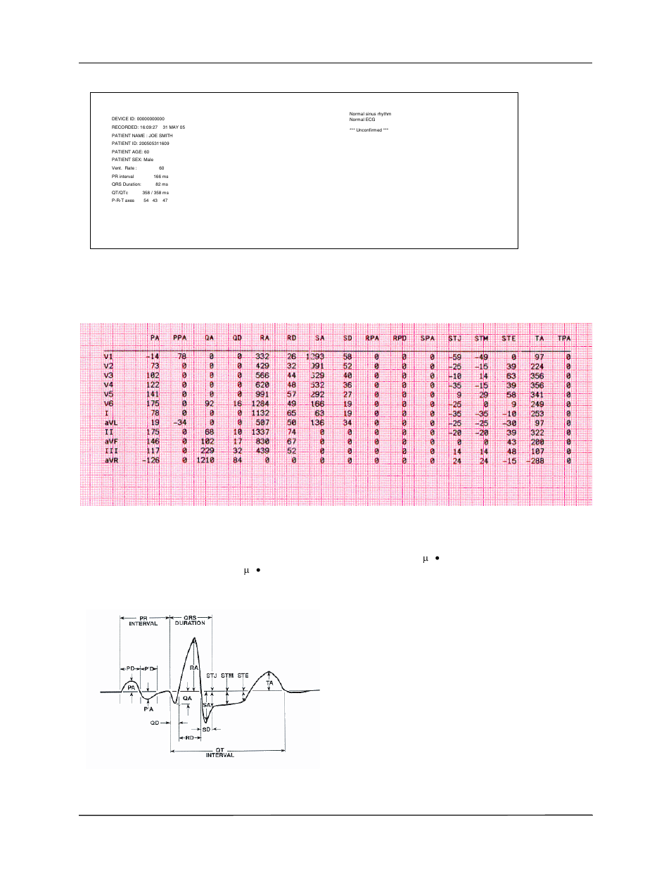 Patient information measurements matrix, 12sl wave measurement | ZOLL E Series Monitor Defibrillator Rev G 12 Lead User Manual | Page 12 / 26