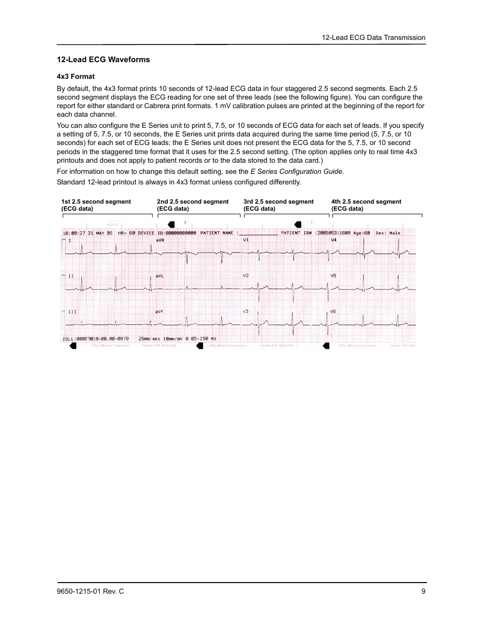 Lead ecg waveforms | ZOLL E Series Monitor Defibrillator Rev C User Manual | Page 11 / 20