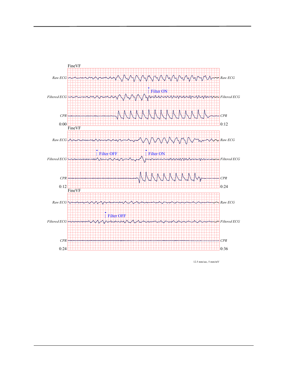 ZOLL E Series Monitor Defibrillator Rev D User Manual | Page 210 / 280