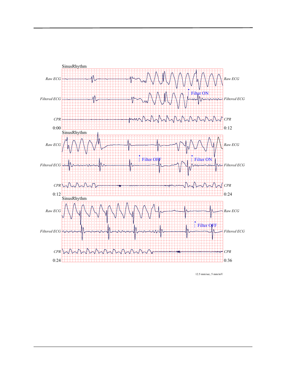 ZOLL E Series Monitor Defibrillator Rev D User Manual | Page 213 / 280
