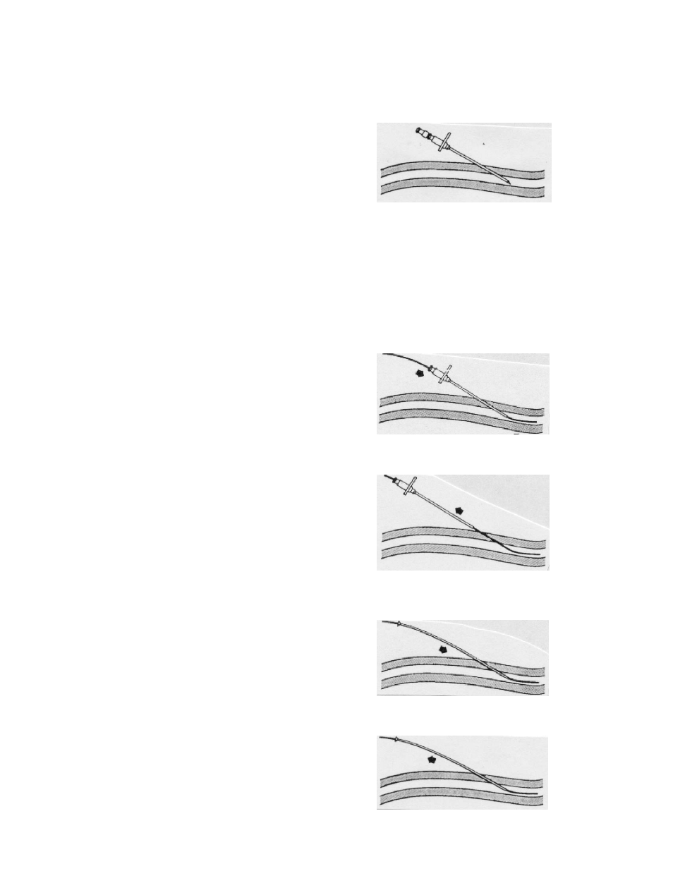 Special instructions for guidewires, Inspection, Cautions | Technique, Cool line, Catheter instructions for use | ZOLL IVTM Catheter Cool Line User Manual | Page 5 / 11