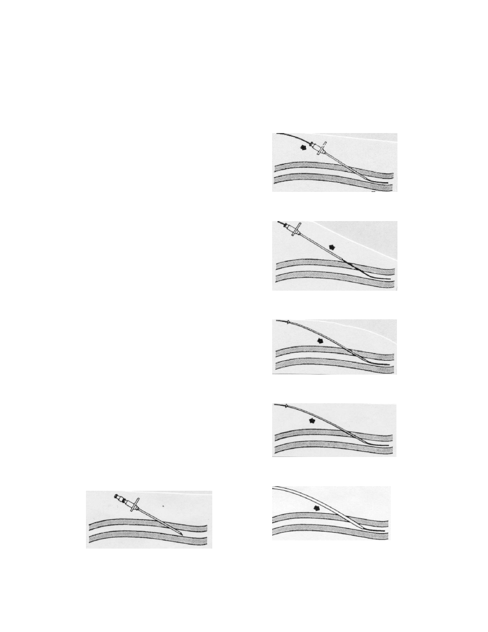 Special instructions for guidewires, Inspection, Cautions | Technique, Quattro | ZOLL IVTM Catheter Quattro User Manual | Page 5 / 11