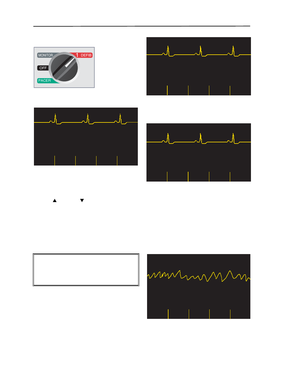 Defib 200j sel, Analyzing ecg, No shock adv | Shock advised | ZOLL M Series Defibrillator Rev YH User Manual | Page 38 / 96