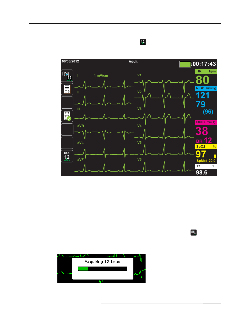 Observing the 12-lead waveform traces, Lead interpretive analysis | ZOLL Propaq M Rev B User Manual | Page 152 / 210