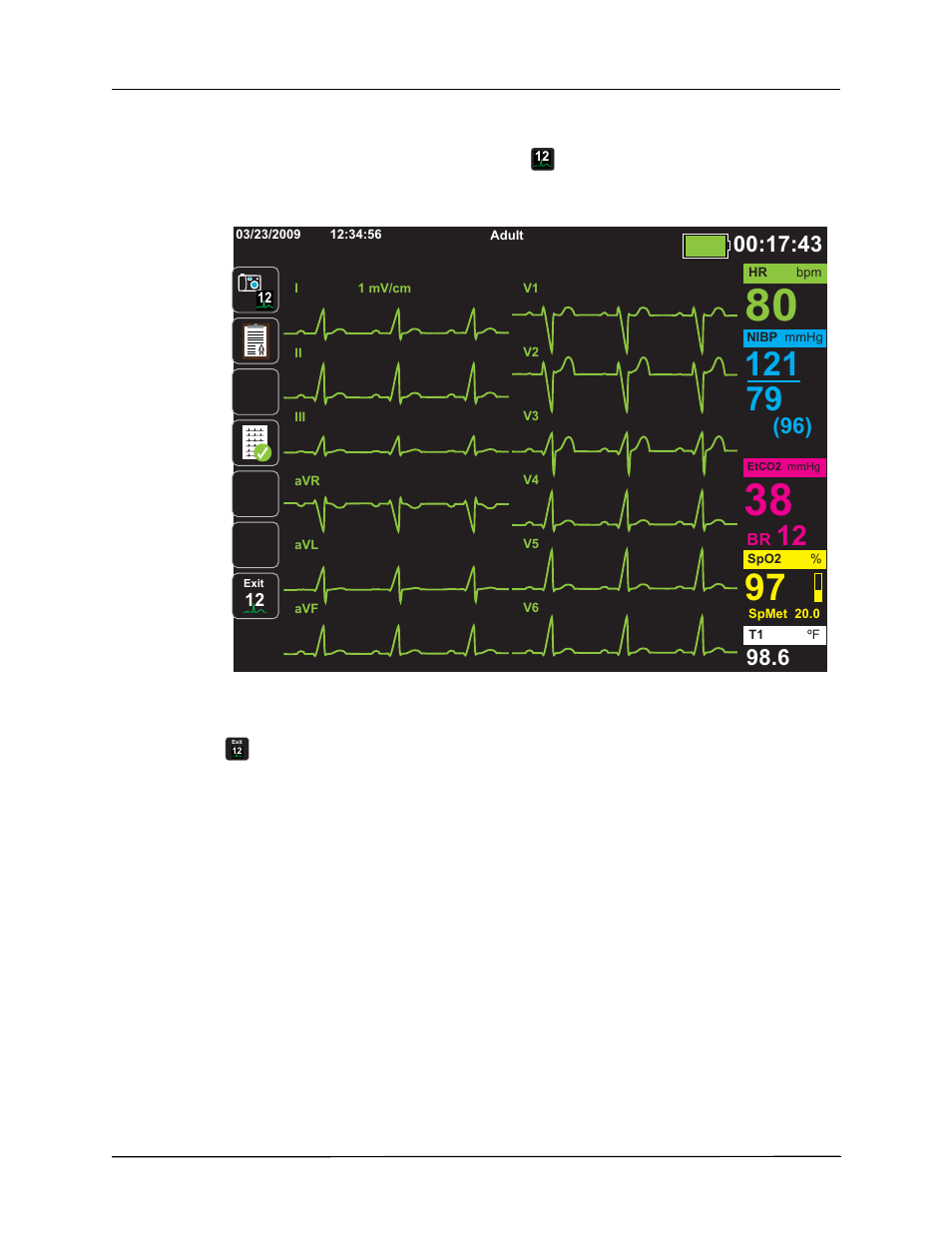 Observing the 12-lead waveform traces | ZOLL Propaq M Rev B User Manual | Page 142 / 170