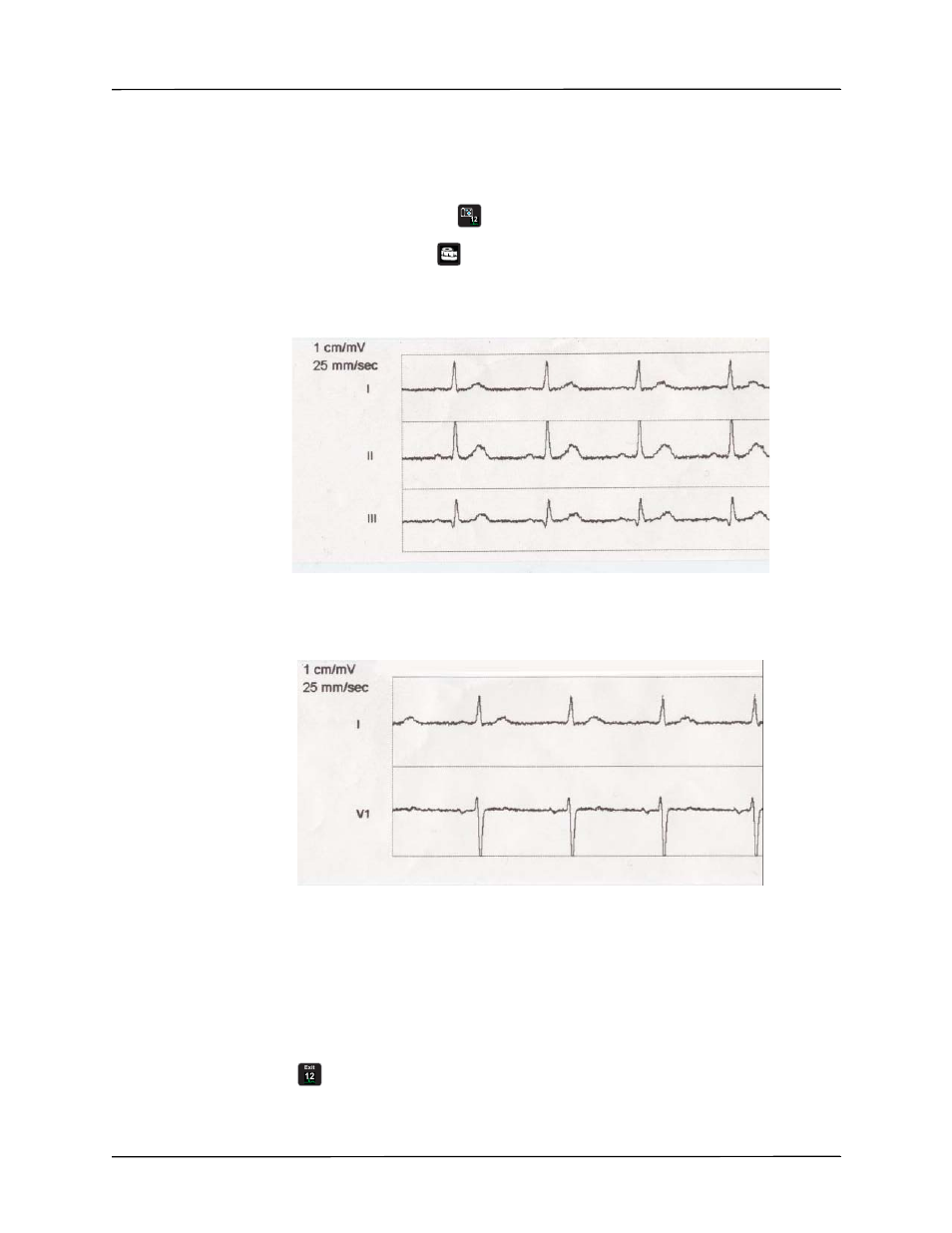 Printing 12-lead waveform traces | ZOLL Propaq MD Rev A User Manual | Page 159 / 238