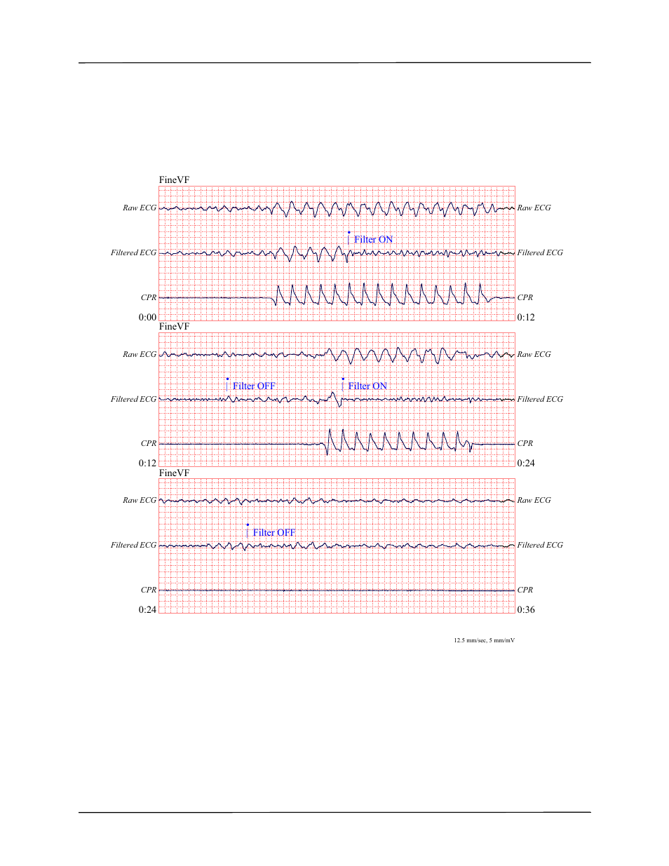 Using see-thru cpr (r series plus only) | ZOLL R Series Monitor Defibrillator Rev J User Manual | Page 259 / 538