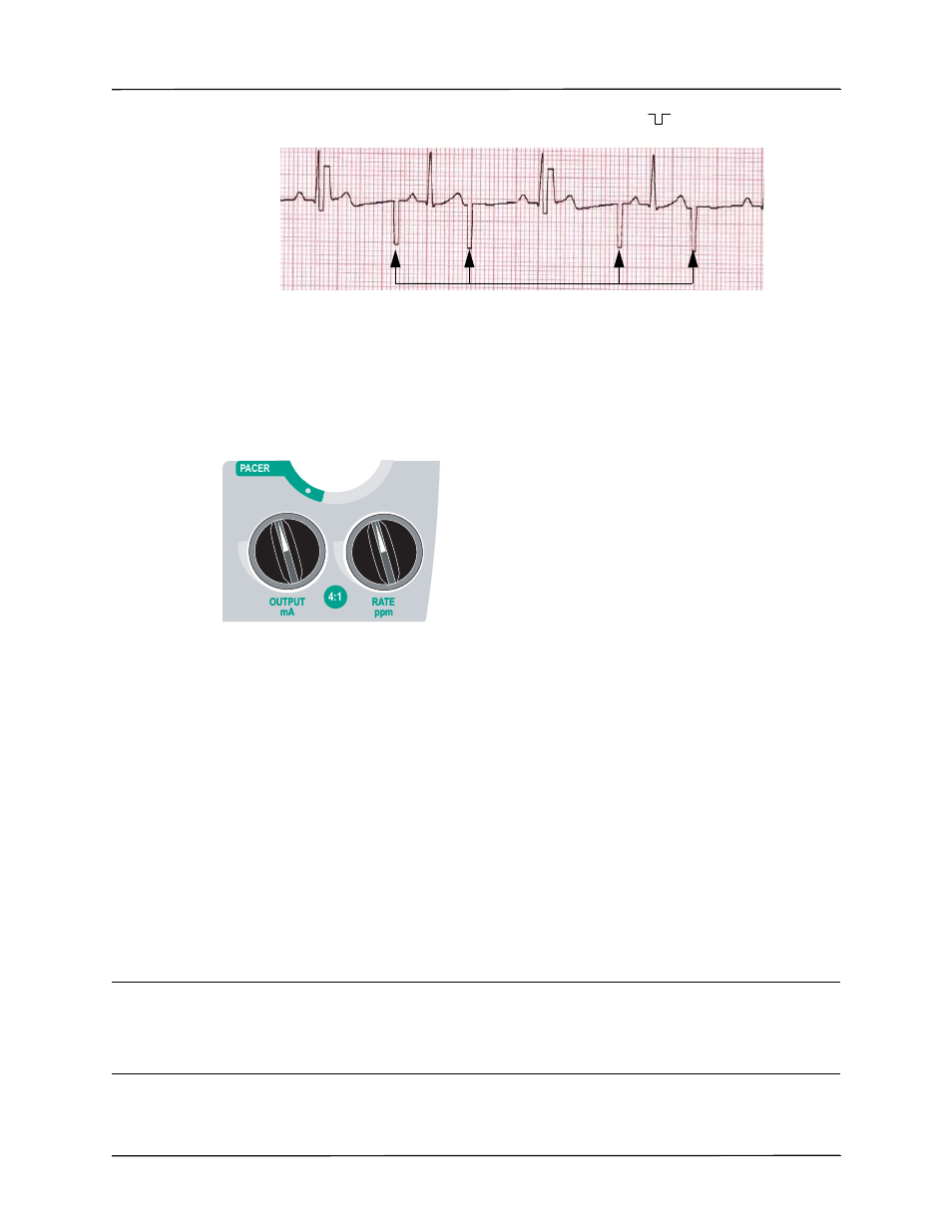 4 set pacer output, 5 determine capture | ZOLL R Series Monitor Defibrillator Rev J User Manual | Page 267 / 538