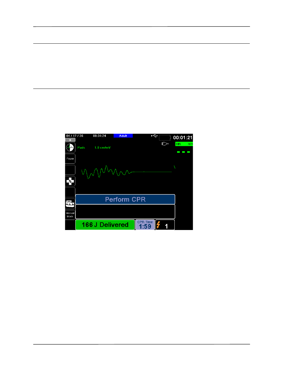 3 press shock | ZOLL X Series Monitor Defibrillator Rev H User Manual | Page 171 / 328