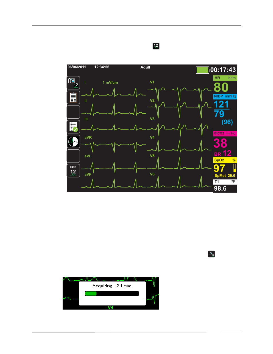 Observing the 12-lead waveform traces, Lead interpretive analysis | ZOLL X Series Monitor Defibrillator Rev H User Manual | Page 182 / 328