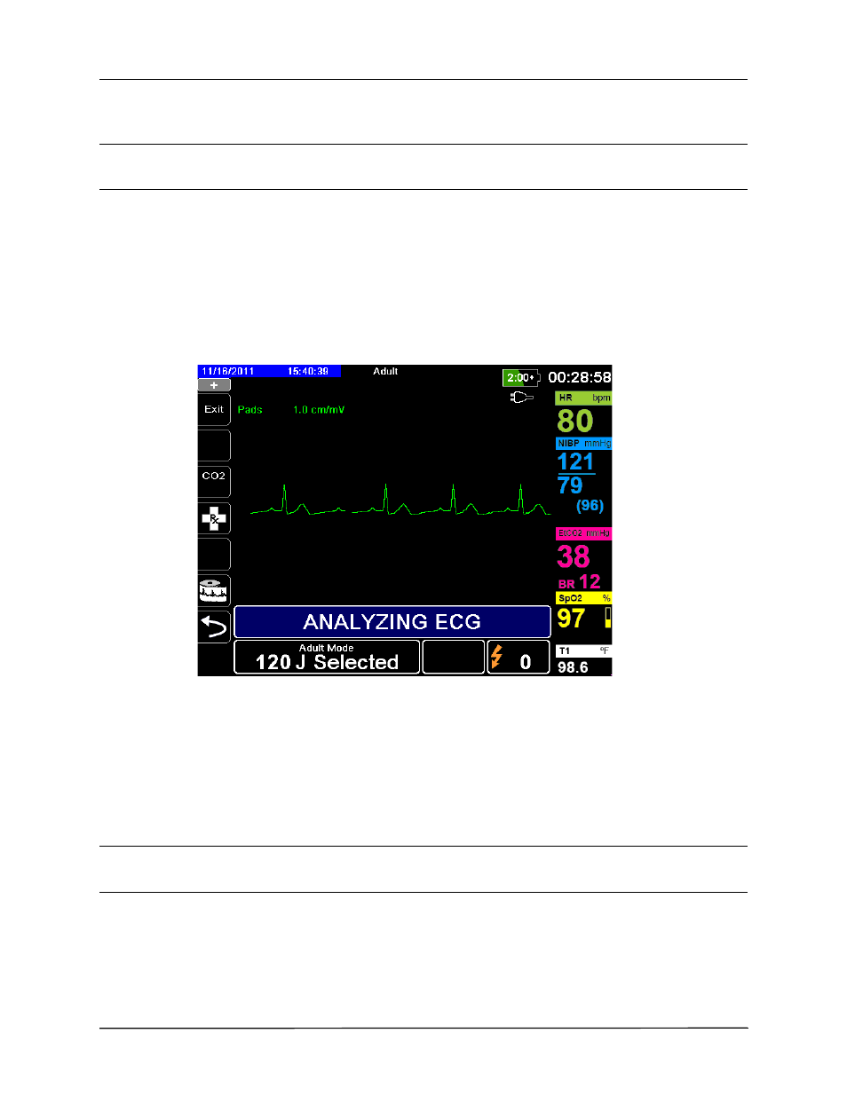 2 press analyze button | ZOLL X Series Monitor Defibrillator Rev H User Manual | Page 214 / 328