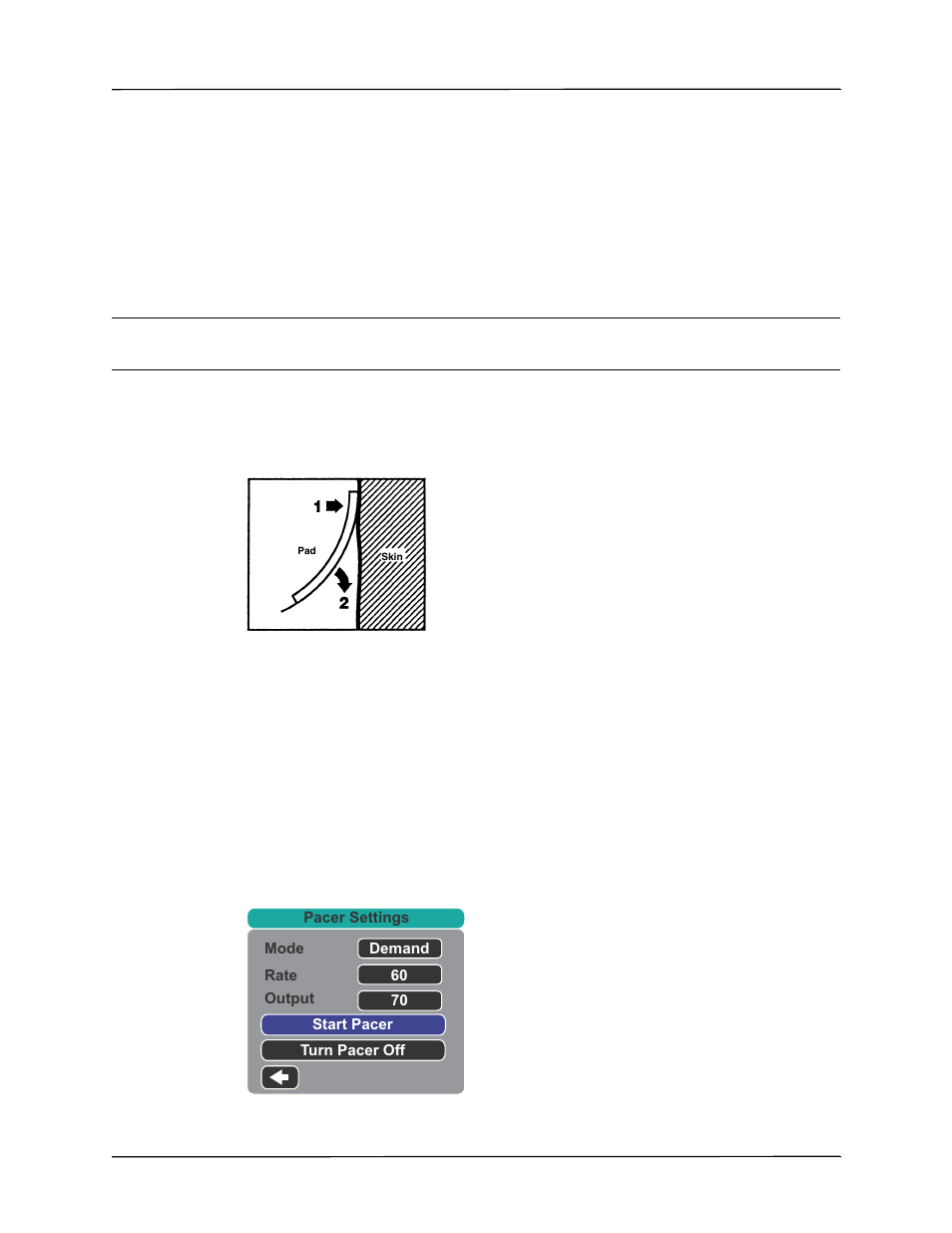 3 press pacer button | ZOLL X Series Monitor Defibrillator Rev H User Manual | Page 219 / 328