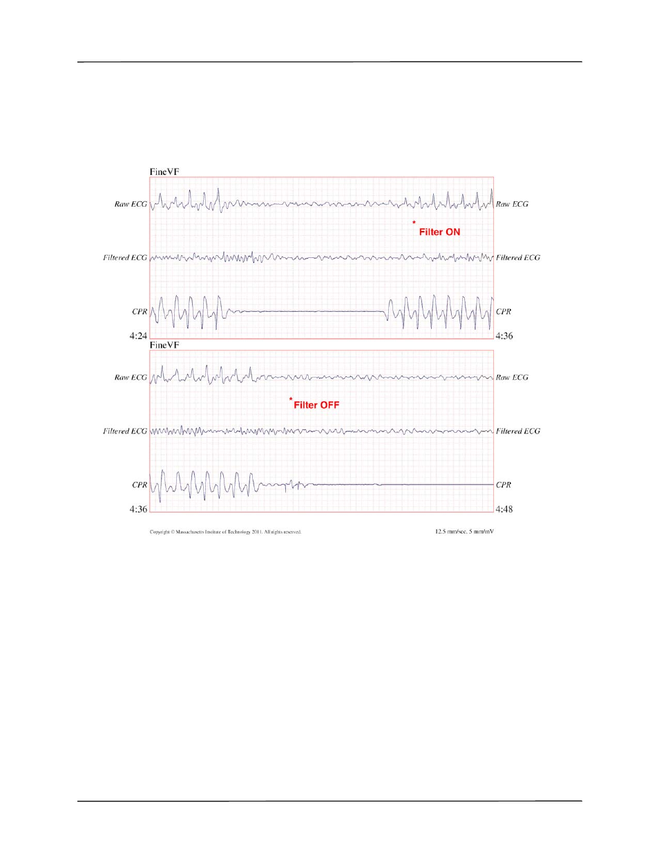 ZOLL X Series Monitor Defibrillator Rev H User Manual | Page 235 / 328