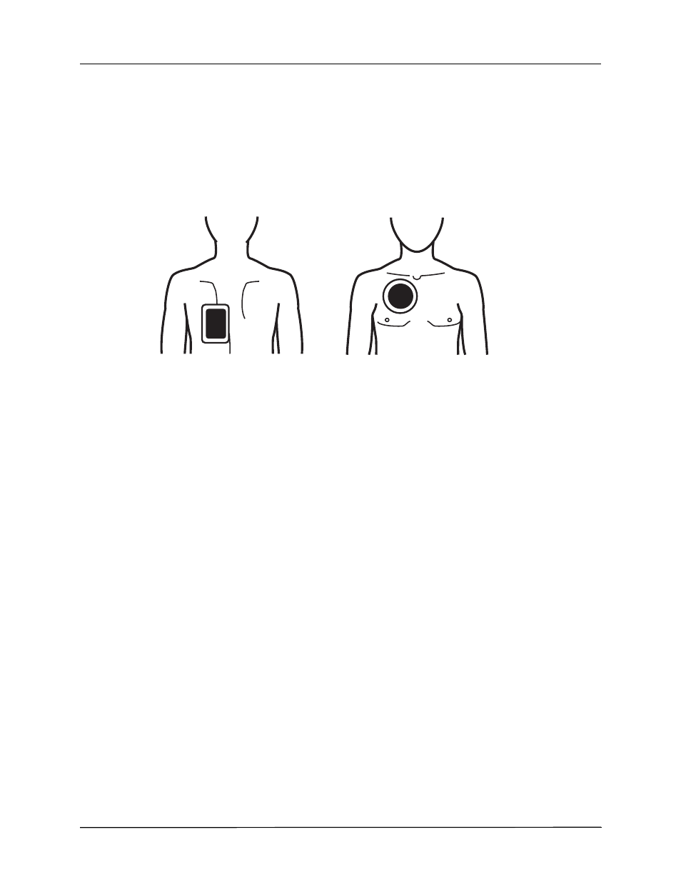 Synchronized cardioversion of atrial fibrillation | ZOLL X Series Monitor Defibrillator Rev H User Manual | Page 314 / 328