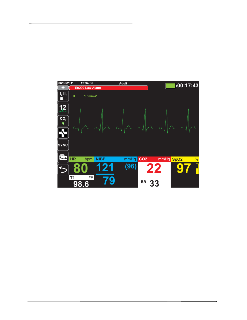 Patient alarm display | ZOLL X Series Monitor Defibrillator Rev H User Manual | Page 79 / 328