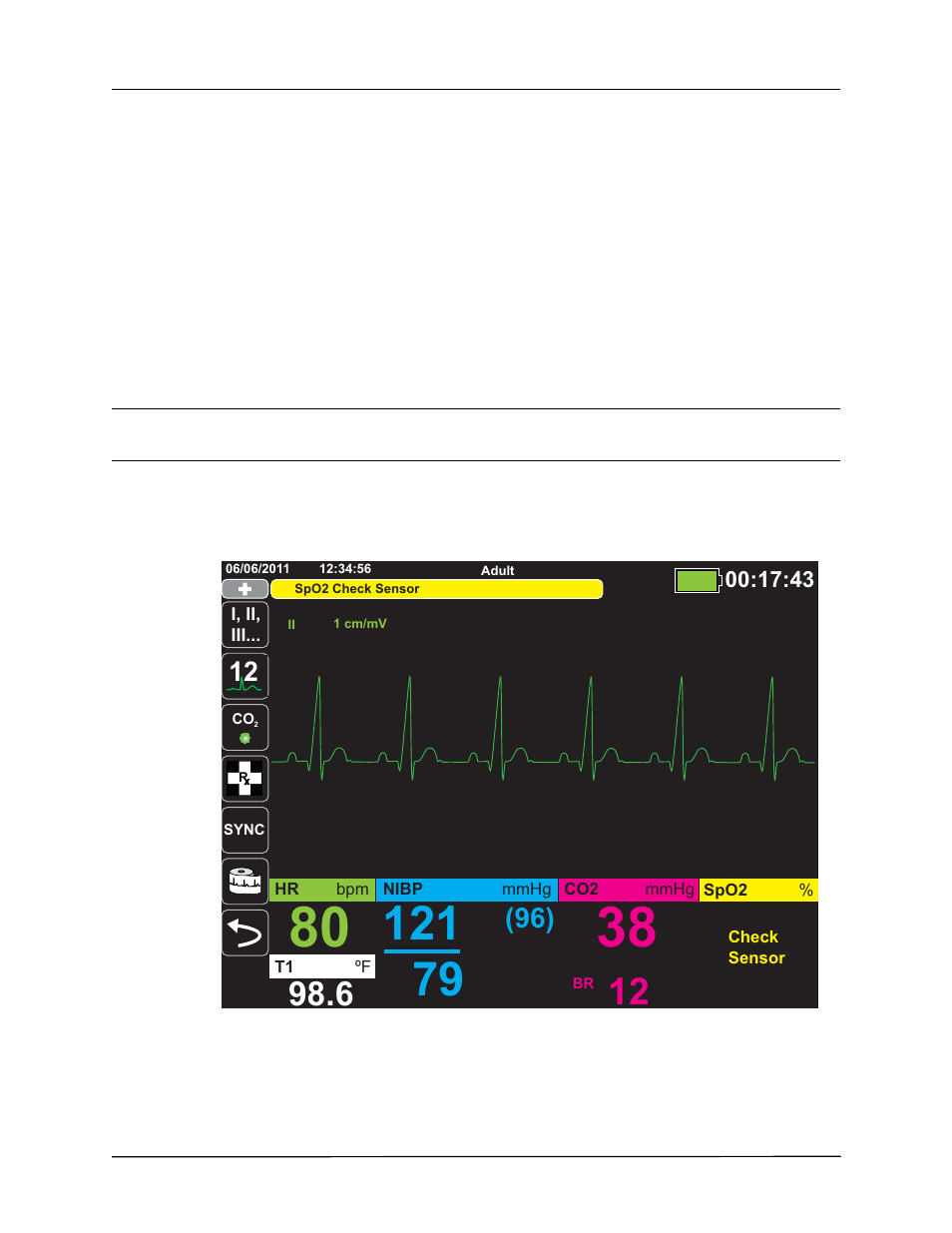 Life threatening rhythm alarms, Equipment alert display | ZOLL X Series Monitor Defibrillator Rev H User Manual | Page 80 / 328