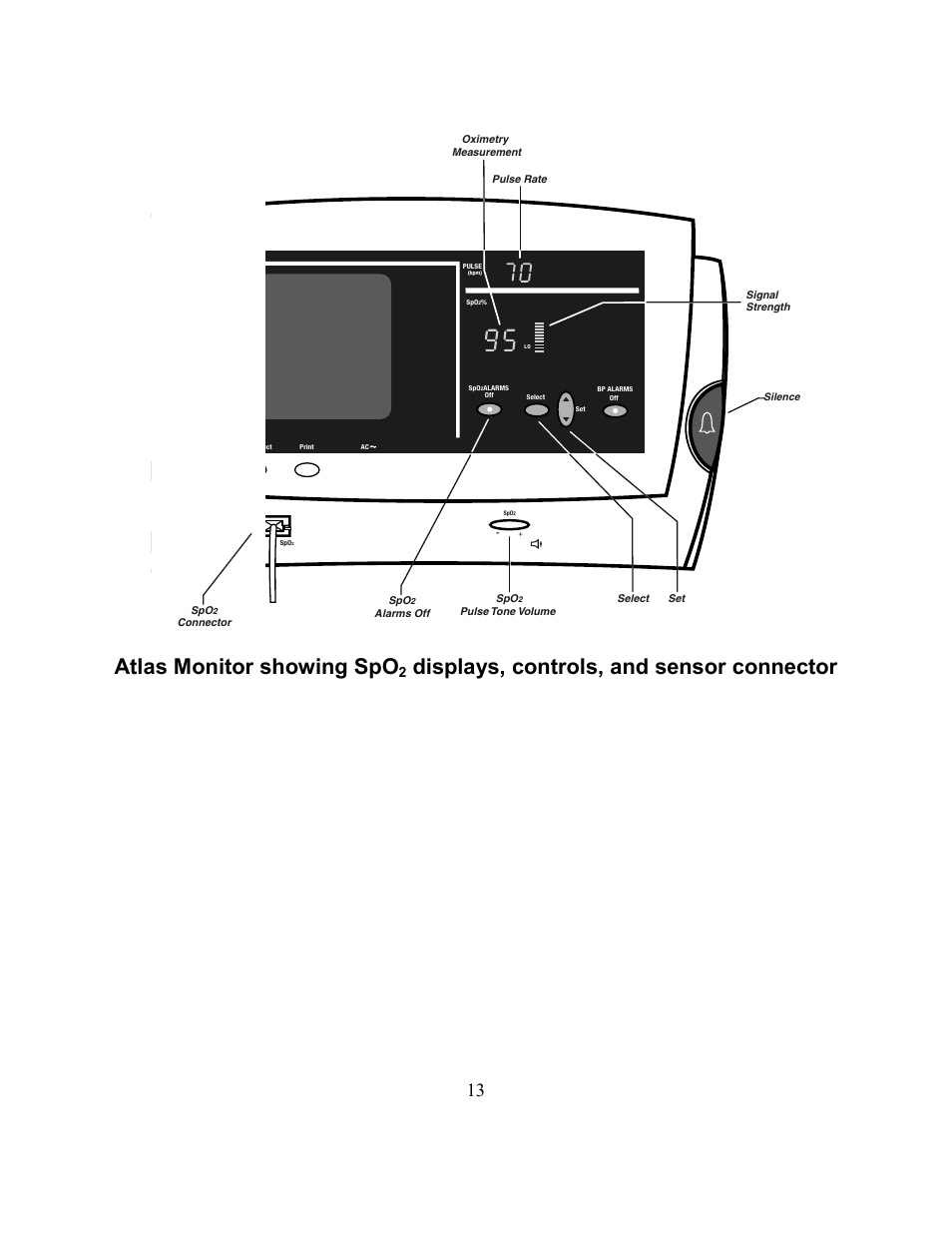 Atlas monitor showing spo, Displays, controls, and sensor connector | Welch Allyn Atlas Monitor - User Manual User Manual | Page 25 / 108