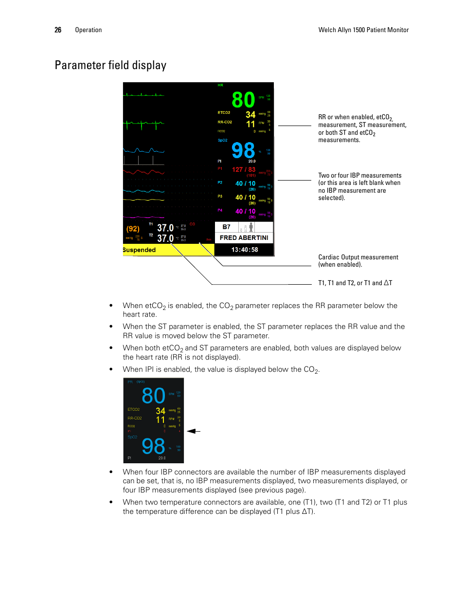 Parameter field display | Welch Allyn 1500 Patient Monitor v.1.3.X - User Manual User Manual | Page 30 / 134