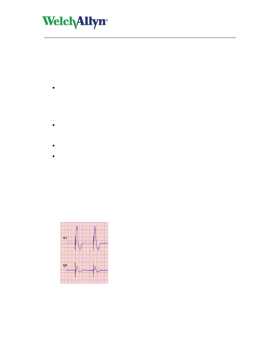Capture an event, Cancel a recording, To cancel a recording | Tips for canceling a recording, Pacemaker pulse detection, Cardioperfect workstation, Resting ecg module - user manual | Welch Allyn CardioPerfect Workstation Resting ECG Module - User Manual User Manual | Page 15 / 54