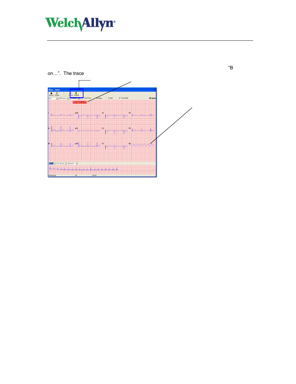 Signal quality indication, Cardioperfect workstation, Resting ecg module - user manual | Welch Allyn CardioPerfect Workstation Resting ECG Module - User Manual User Manual | Page 16 / 54