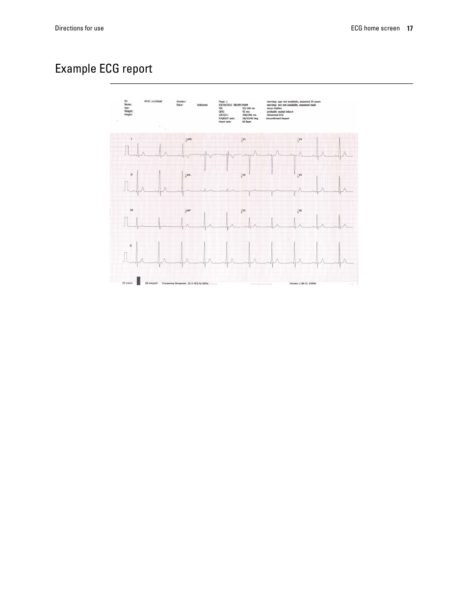 Example ecg report | Welch Allyn CP 150 12-lead resting electrocardiograph v.2.00.XX - User Manual User Manual | Page 21 / 58