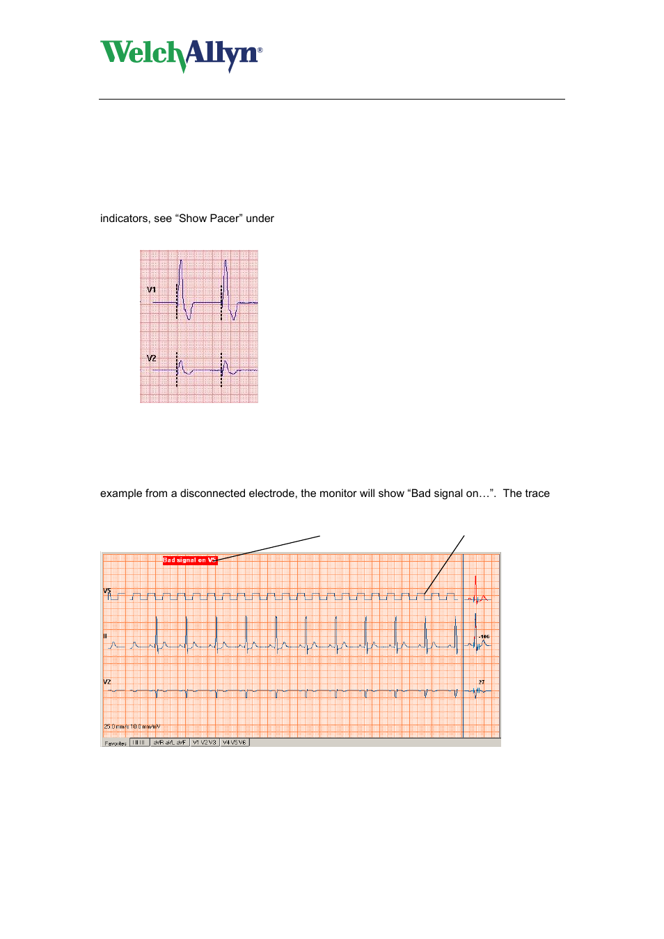 Pacemaker pulse detection, Signal quality indication | Welch Allyn CardioPerfect Workstation Exercise ECG Module - User Manual User Manual | Page 25 / 83