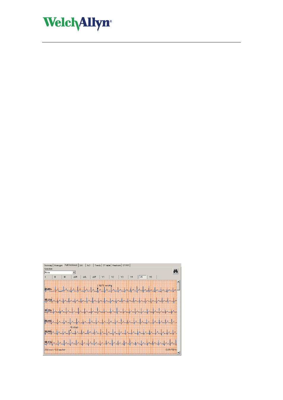 Change qrs onset and qrs end markers, 5 work with the full disclosure view, Full disclosure view | Work with the full disclosure view | Welch Allyn CardioPerfect Workstation Exercise ECG Module - User Manual User Manual | Page 33 / 83