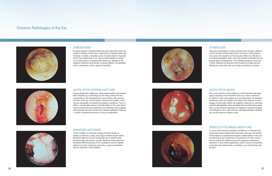 Common pathologies of the ear | Welch Allyn A Guide To The Use Of Diagnostic Instruments In Eye And Ear Examinations - Quick Reference Guide User Manual | Page 14 / 16