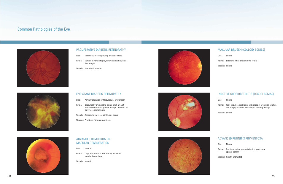 Common pathologies of the eye, Proliferative diabetic retinopathy, End stage diabetic retinopathy | Advanced hemorrhagic macular degeneration, Macular drusen (colloid bodies), Inactive chorioretinitis (toxoplasmas), Advanced retinitis pigmentosa | Welch Allyn A Guide To The Use Of Diagnostic Instruments In Eye And Ear Examinations - Quick Reference Guide User Manual | Page 8 / 16