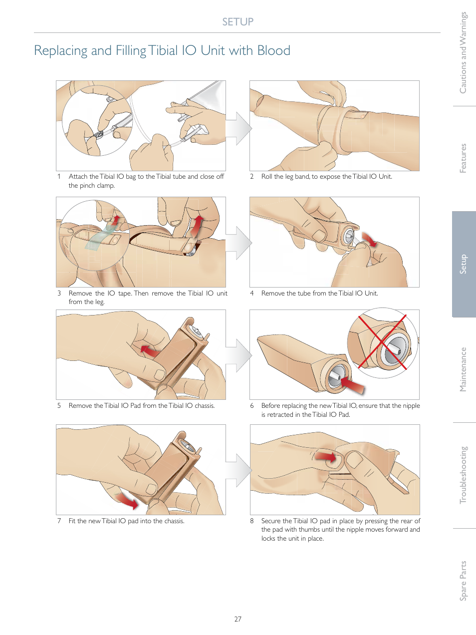 Replacing and filling tibial io unit with blood, Setup | Laerdal SimMan Essential Bleeding User Manual | Page 27 / 46