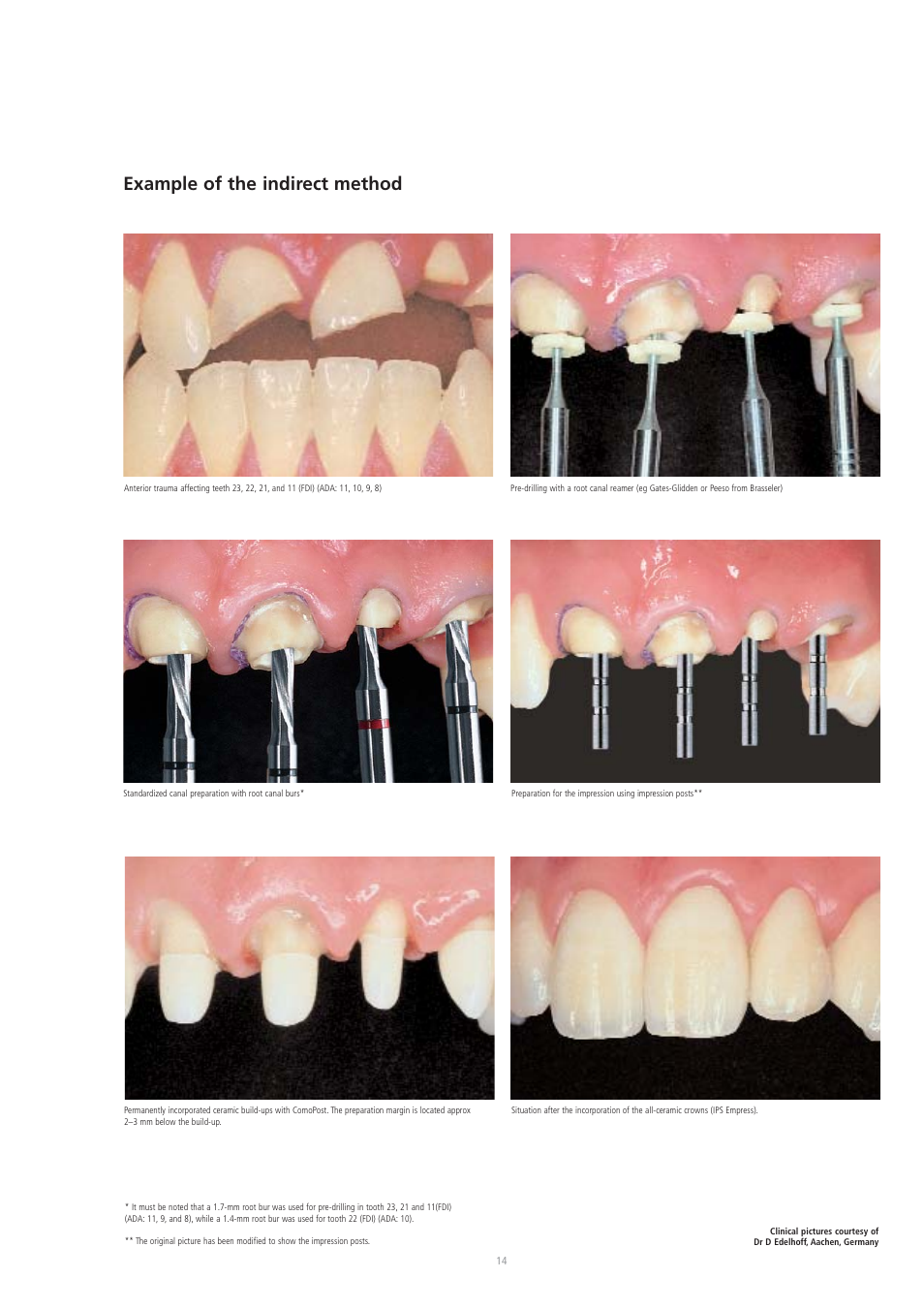 Example of the indirect method | Ivoclar Vivadent CosmoPost User Manual | Page 14 / 24