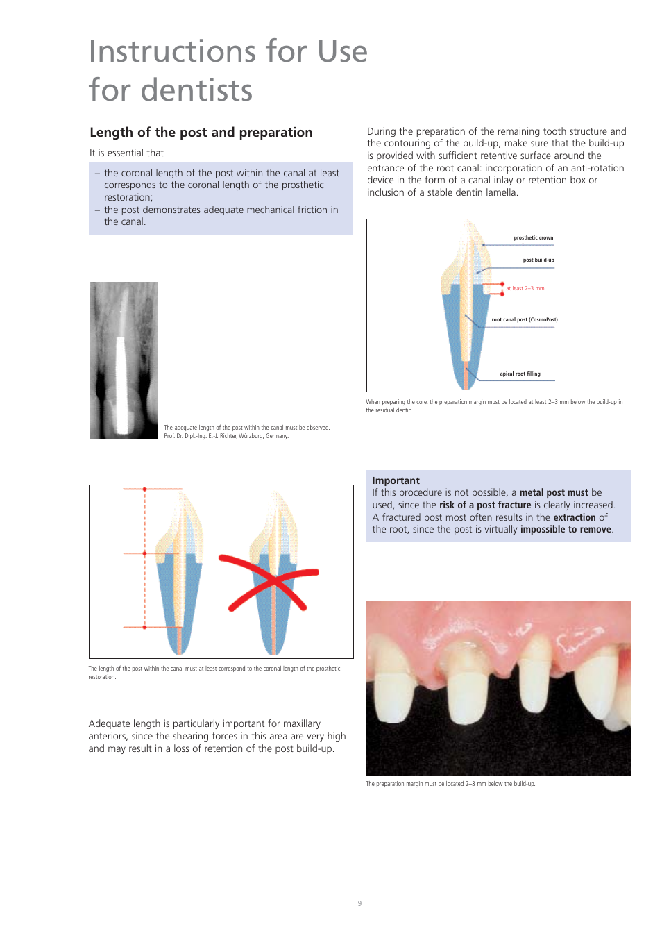 Instructions for use for dentists, Length of the post and preparation | Ivoclar Vivadent CosmoPost User Manual | Page 9 / 24